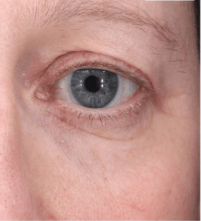 Close-up of a person's eye with blue iris and pinkish eyelids.