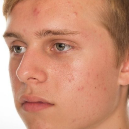 Before and after comparison of a young man's face with acne on a white background