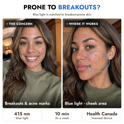 Breakout-prone skin, and the cheek area that the mask's blue 415 nm light targets
